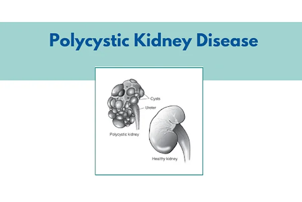 Kidney Cyst