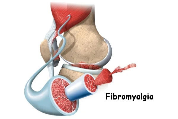 Fibromyalgia