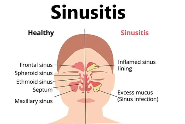 Sinusitis 