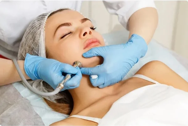 Microdermabrassion 