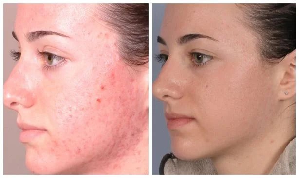 Microneedling