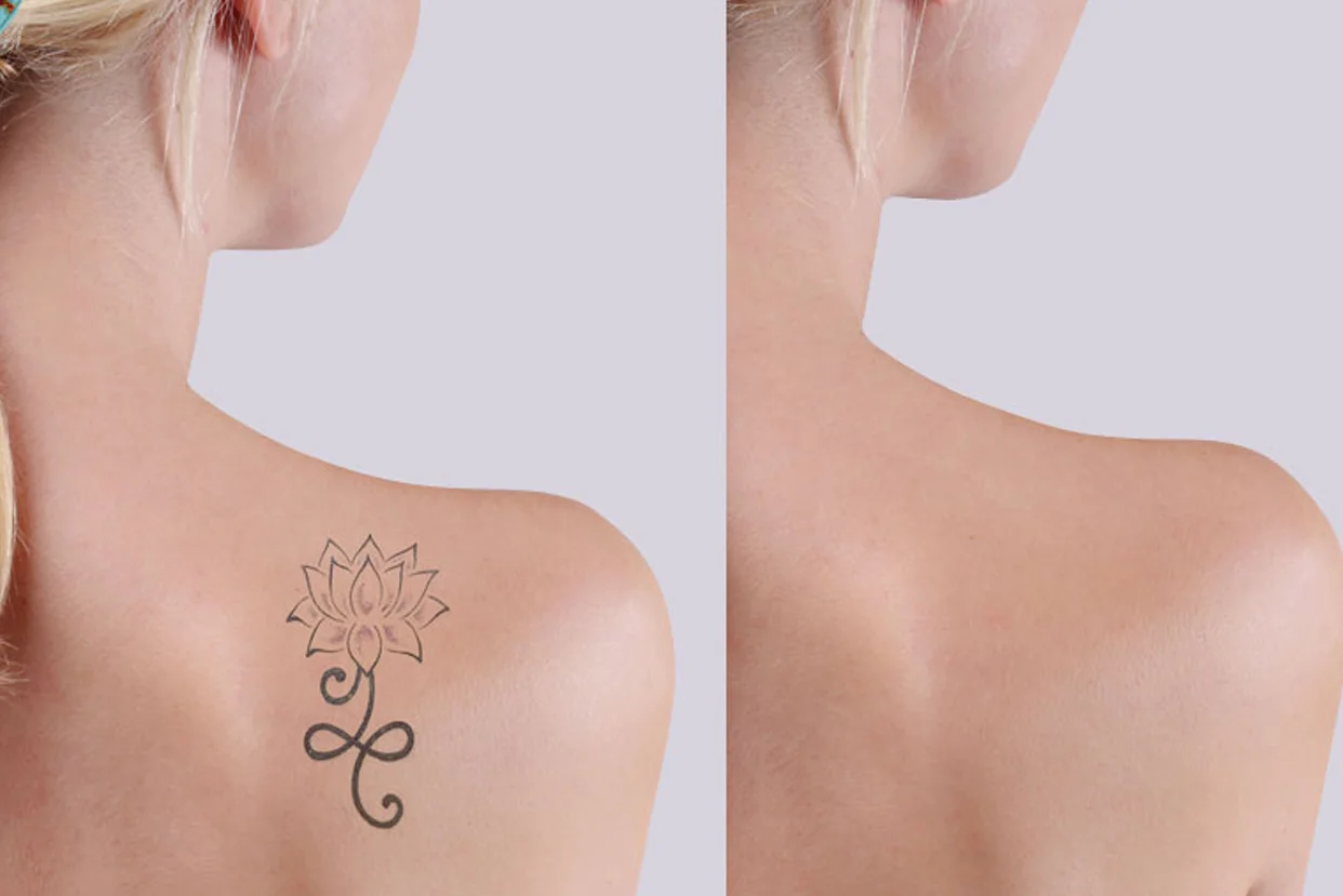 Tattoo Removal