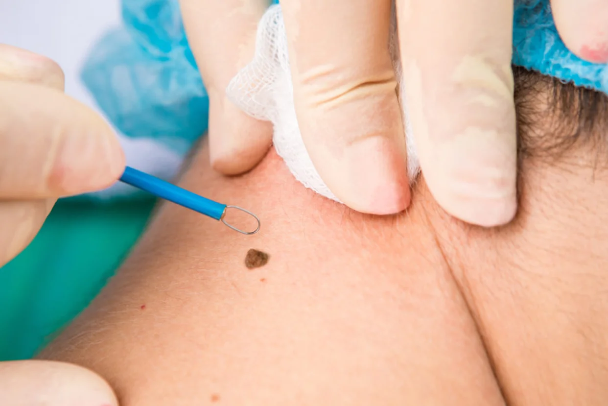 Wart/ Moles/ Skin Tags removal
