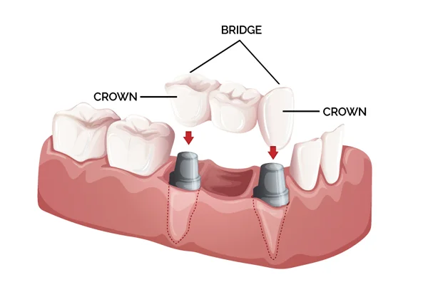 Crowns and Bridges