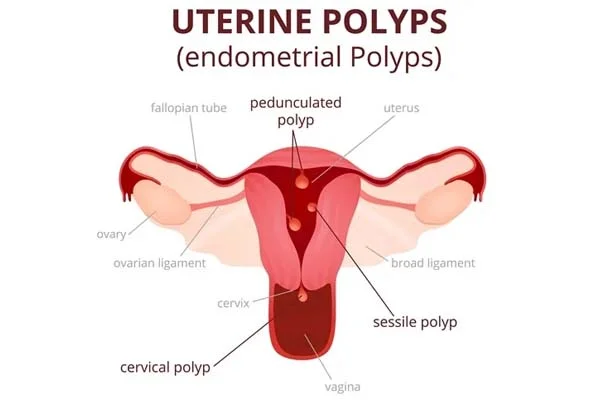 Gynaecology